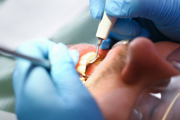 Best Emergency Wisdom Tooth Extraction in Arial, SC
